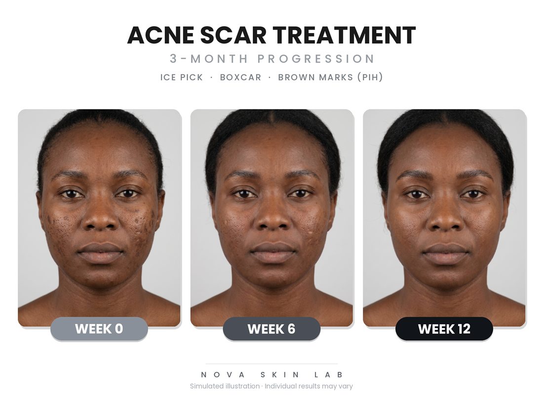 Acne scar 3-month progression illustration — ice pick, boxcar, and brown marks (PIH)