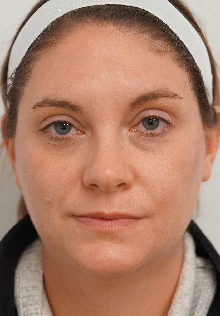 BBL HEROic · Face example 1: after, Post BBL HEROic Face | 1 tx