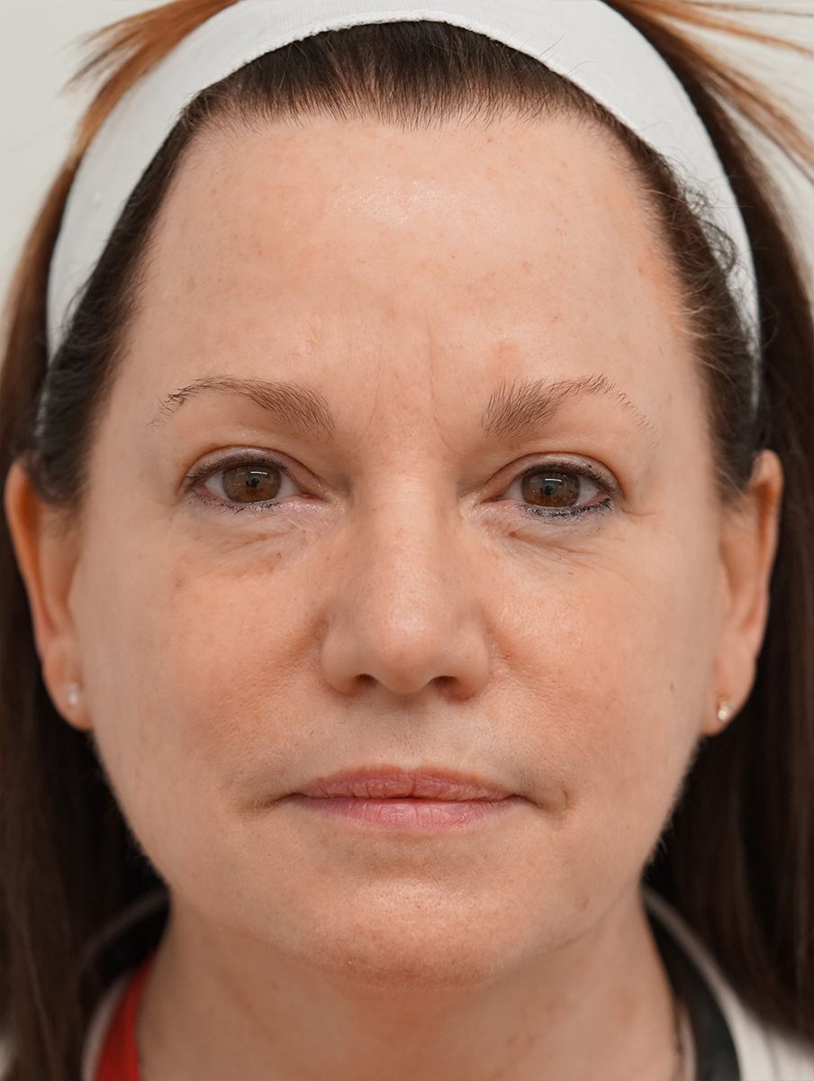 BBL HEROic · Face example 2: after, Post BBL HEROic Face | 1tx