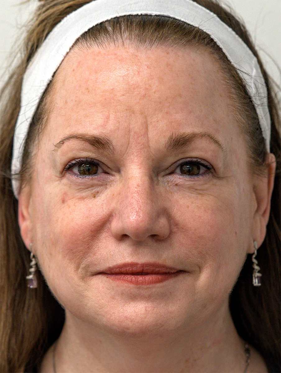 BBL HEROic · Face example 2: before, photograph published by Sciton