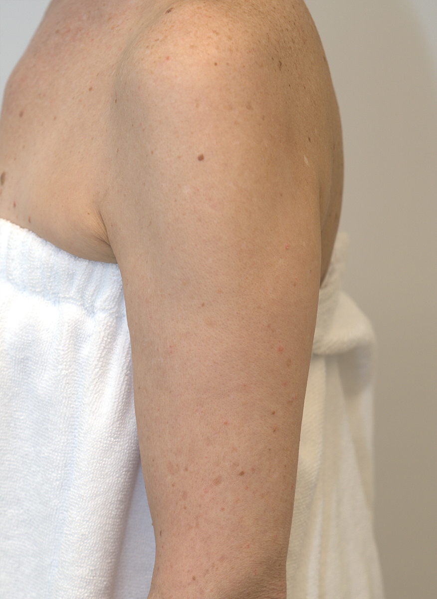 BBL HEROic · Arm example, after: Post BBL HEROic Body | 2 tx